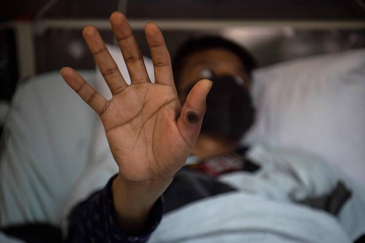 Pasien cacar monyet menunjukkan kulit yang terinfeksi virus di tangannya.