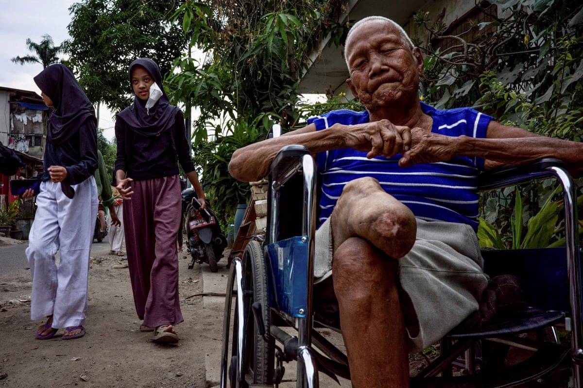 Pengidap kusta yang menjadi penyandang disabilitas.