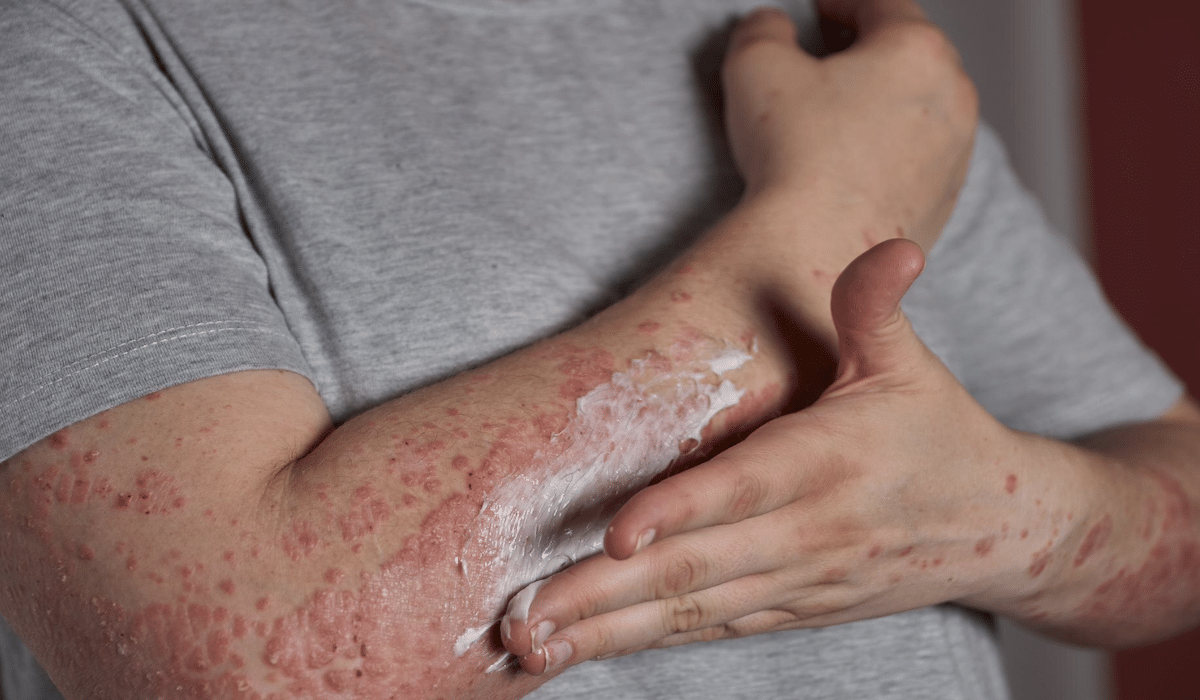 Ilustrasi penderita cacar monyet (monkeypox atau Mpox)