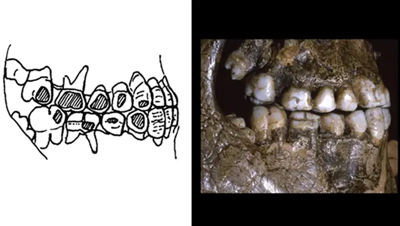 Cheek piercings in the ice age reveal the mystery of the wear of ancient European teeth